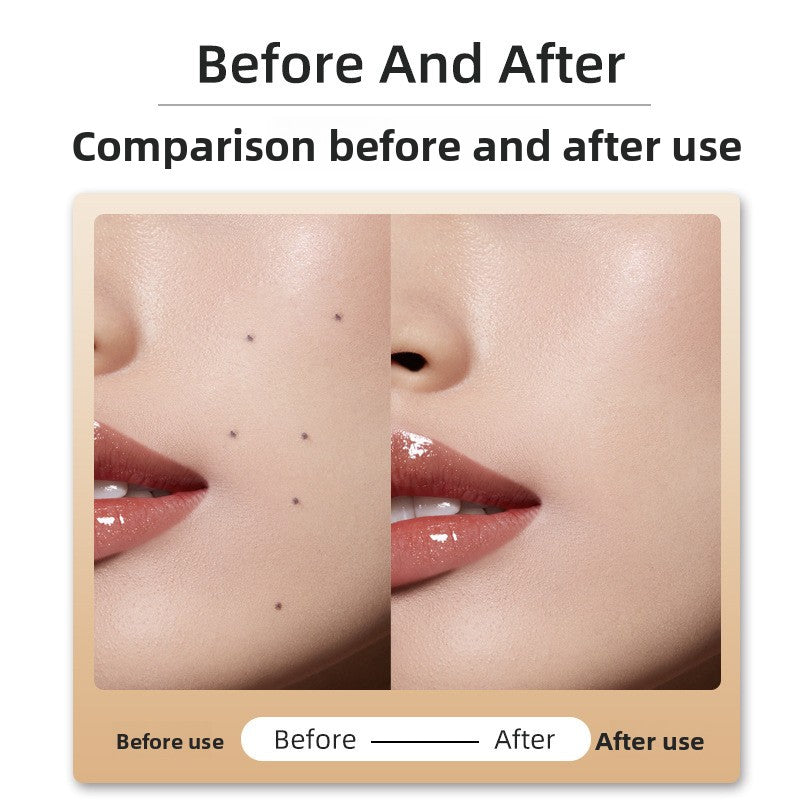 Laser mole remover